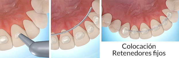 retenedores-ortodoncia-fijos
