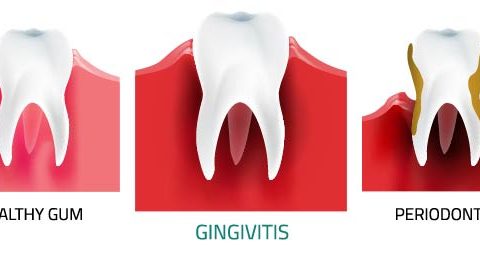 Giovanni Arenas - Gingivitis