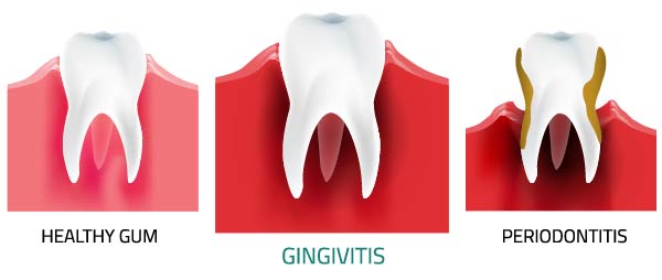 Giovanni Arenas - Gingivitis